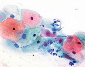 Papanicolaou's solution 3b polychromatic solution EA 50 for cytological cancer and cycle diagno